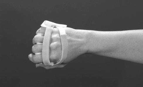 A A FIGURE 11. The hand-based LM splint. (A) Dorsal view showing 2 Velcro straps and 4 soft-core, wire foam separators designed to prevent ulnar deviation of the metacarpophalangeal (MCP) s.