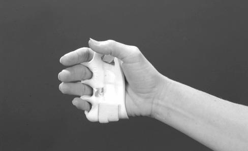 It is, however, a challenge to design a splint that simultaneously blocks radial deviation of the wrist while not compromising the effectiveness of blocking ulnar drift at the MCP s, and vice versa.