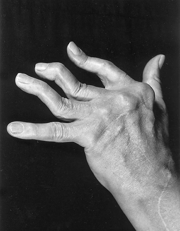 FIGURE 5. A hand of a person with severe rheumatoid arthritis. Note the ulnar drift of the metacarpophalangeal (MCP) s of the fingers. The MCP of the index finger is also palmarly dislocated.