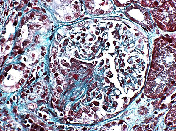 cytoplasmic antibody-associated vasculitis: a randomised controlled