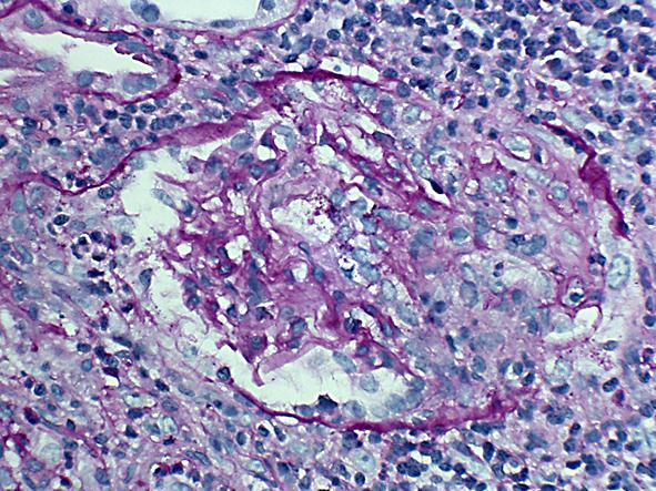 Transplant renal biopsy of patient 1 showing characteristic crescentic