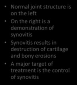 treatment is the control of synovitis Rheumatoid Arthritis Major Target Rheumatoid