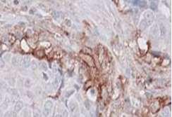 PD-L1 expression levels within a tumour are heterogeneous PD-L1+ PD-L1- MedImmune, images