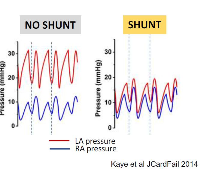 Left Atrial Decompression: IASD Rationale Computer simulation demonstrated that an 8mm interatrial shunt