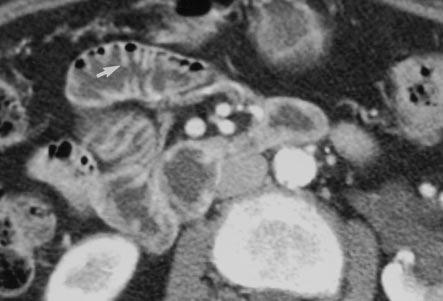 CT of owel Wall Thickening: Significance and Pitfalls of Interpretation C T has become the most important imaging technique for evaluating the abdomen and pelvis.
