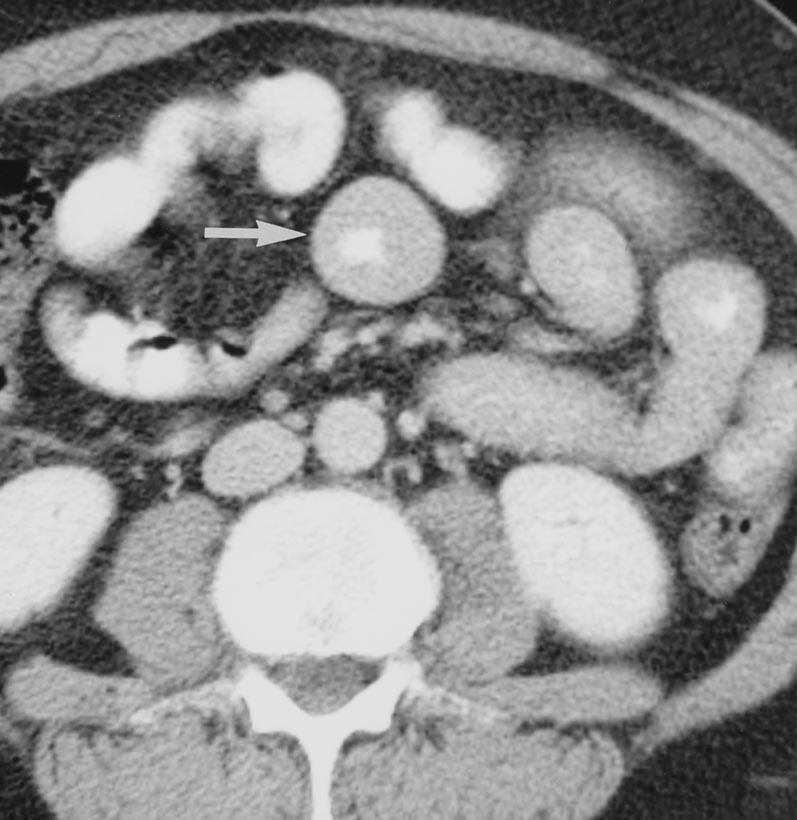 The CT findings that need to be analyzed when assessing thickened bowel include pattern of attenuation; degree of thickening; symmetric versus asymmetric thickening; focal, segmental, or diffuse