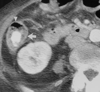 Normal colonic wall thickness in 81-year-old woman with breast cancer. Contrast-enhanced axial CT scan of cecum suggests bowel wall thickening with target appearance (arrow ).