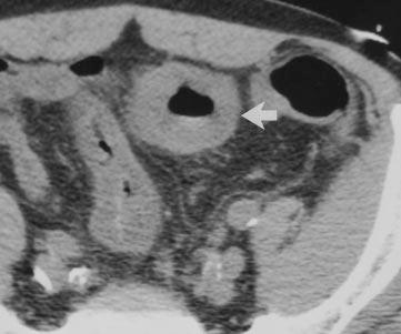 , xial CT scan through upper abdomen shows apparent homogeneous circumferential thickening of wall of jejunum loops (arrow ), a finding suspicious for lymphoma.