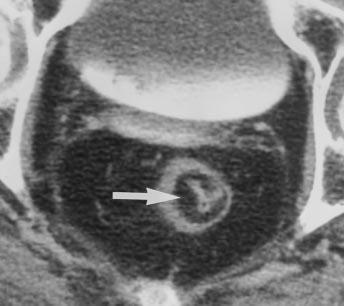 CT of owel Wall Thickening Fig. 5. Deposition of fat in submucosa producing target sign in 85-year-old man with history of chronic ulcerative colitis.