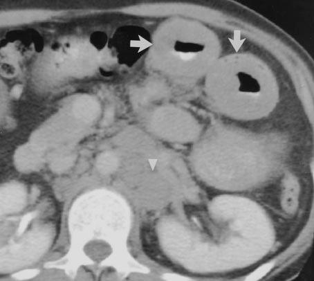 CT of owel Wall Thickening Fig. 10. Well-differentiated adenocarcinoma in 26-year-old man with bowel obstruction.