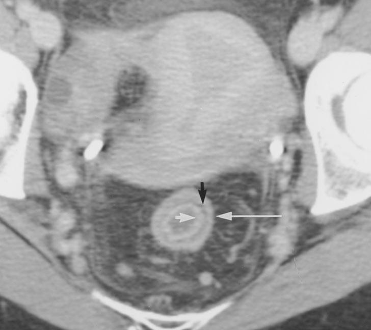 Contrast-enhanced axial CT image of rectum shows mild wall thickening with classic target appearance and inner enhancement of mucosa (short white arrow ) and outer enhancement of muscular layer (long