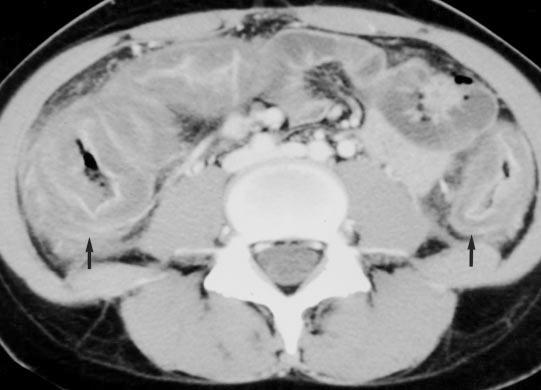CT of owel Wall Thickening Fig. 17. Diffuse marked colonic thickening with target appearance in pseudomembranous colitis in 18-year-old woman with diarrhea.