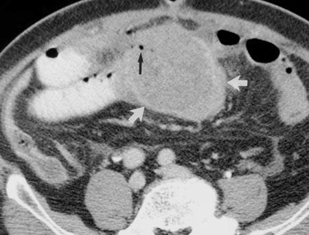 Contrast enhanced axial CT image shows large bulky exophytic mass extending from jejunum with heterogeneous attenuation (white arrows).
