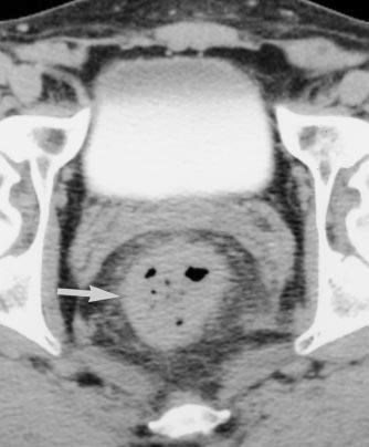 Segmental or diffuse thickening may be seen in patients with small-bowel vasculitis, as often occurs in systemic lupus erythematosus [35 37] (Fig 12). Fig. 20.