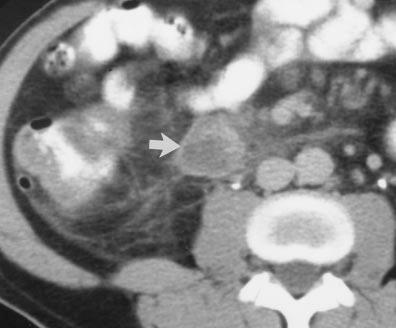 Contrast-enhanced axial CT image shows mild circumferential wall thickening of ascending and descending colons (arrows). Diffuse mild colitis suggests infection or ulcerative colitis.