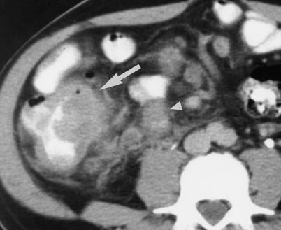 These associated findings include lymph nodes; mesenteric stranding and calcification; abscess, sinus tracts, and fistulas; proliferation of fat; vascular occlusion; and solid organ abnormalities.