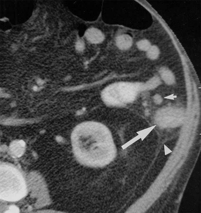 CT of owel Wall Thickening Fig. 23. enign versus malignant colonic lesion: importance of lymphadenopathy.