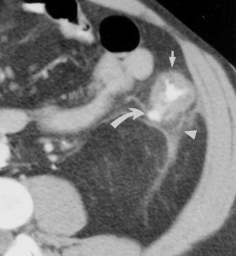 Small diverticulum is present (curved arrow ). Findings are consistent with mild focal diverticulitis, which resolved after antibiotic therapy., 66-year-old man with left-sided abdominal pain.
