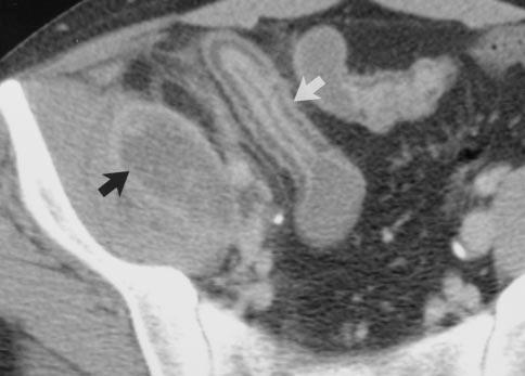 Contrast-enhanced axial CT image of abdomen shows soft-tissue mass with small calcifications (black arrow ) in mesentery (straight white arrow ).