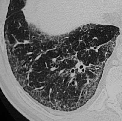 Am J Respir Crit Care Med 2011; 183: 788-824 Inconsistent with UIP pattern (any of the seven features): Upper or mid-lung predominance Peribronchovascular predominance Extensive ground glass