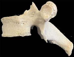 body vertebral foramen