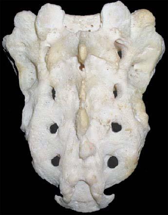 Sacrum (5 fused vertebrae) sacral canal