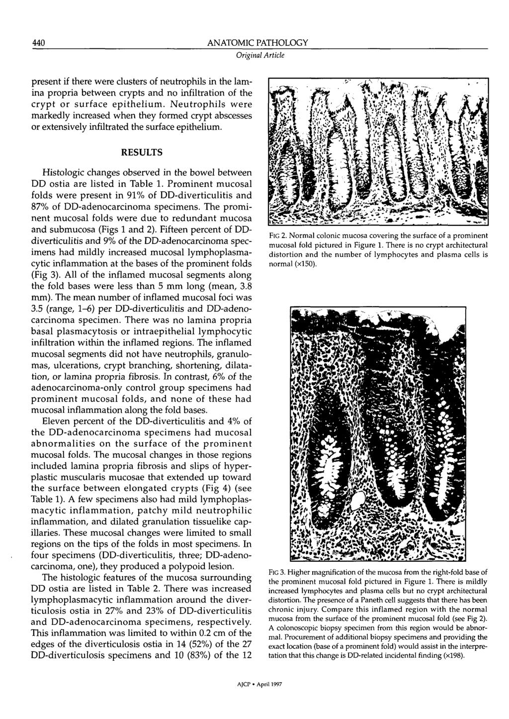 ANATOMIC PATHOLOGY 440 Original Article present if there were clusters of neutrophils in the lamina propria between crypts and no infiltration of the c r y p t or surface e p i t h e l i u m.