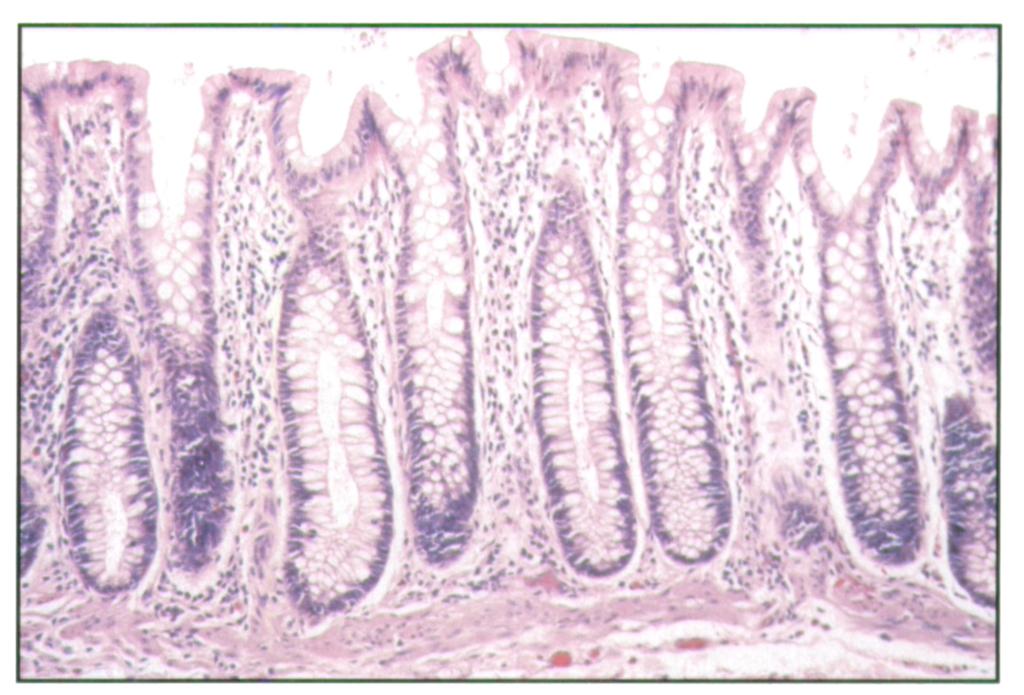RESULTS Histologic changes observed in the bowel between DD ostia are listed in Table 1. Prominent mucosal folds were present in 9 1 % of DD-diverticulitis and 87% of DD-adenocarcinoma specimens.