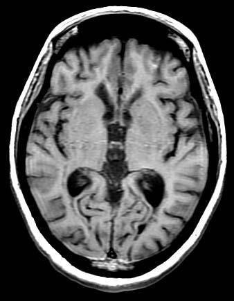 MRI Sequences for our patient WM T1WI hypointense lesion Patient WM Axial View