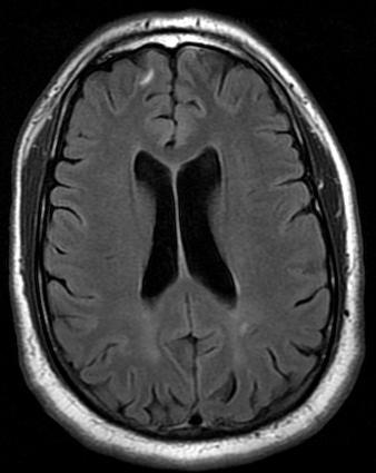 Cortical Atrophy Our patient WM compared with Companion Patient #1 Cortical Atrophy