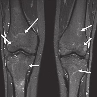 MRI of Osteonecrosis Associated With Pediatric Acute Lymphoblastic Leukemia undergone allogeneic bone marrow transplantation has allowed us to observe subtle signal changes in knees and hips that