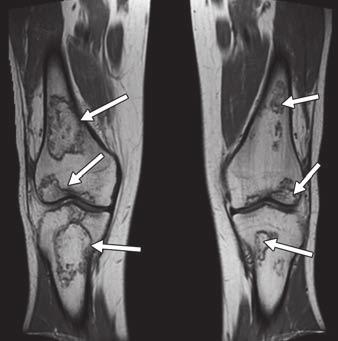 Jude institutional review board, we reviewed the prospectively acquired MRI screening studies of hips and knees of 481 patients with ALL performed between 2001 and 2011.