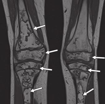 femoral heads on follow-up studies, with complete MRI evidence of collapse of both femoral heads 2.5 years after the first screening study (Figs.