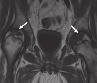 seen. C and D, T1-weighted (C) and STIR (D) images show articular collapse (arrows) of femoral heads bilaterally on follow-up MRI performed 2.5 years later.