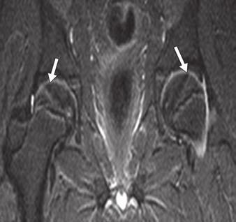 Furthermore, in 10 of 20 cases (50%), the frank osteonecrotic lesions were confined to the outlines and contours of the early signal changes.
