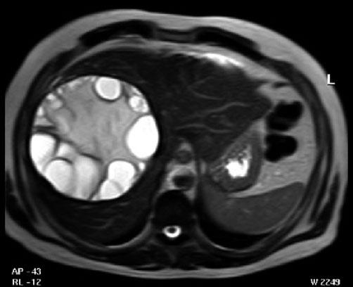 Imaging of Diffuse and Inflammatory Liver Disease 93 a b Fig. 5 a, b. Echinococcus granulosus cyst in a 28-year-old man with right upper quadrant pain.