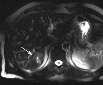 c, d T1- weighted images with liver-specific contrast agent in axial and coronal planes show homogenous uptake of the liver-specific agent, typical for FNH (arrow).