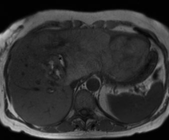100 W. Schima, R. Baron Fig. 6 a-d. Hepatocellular adenoma (HCA). a T1-weighted in-phase GRE images demonstrate a very large mass in a young woman.