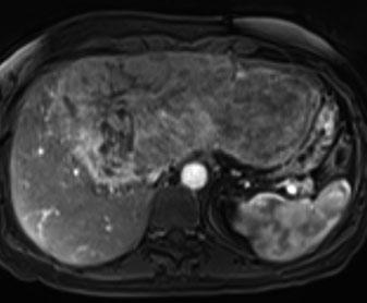 a Arterial-phase CT shows strong and progressive contrast enhancement, which is retained in the b delayed phase and is typical for peliotic changes in inflammatory adenoma a b and demonstrate higher