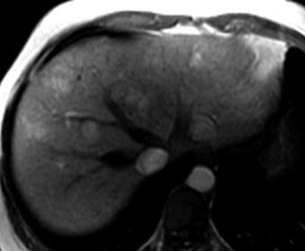 US reveals a cystic lesion with internal echoes.
