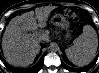 Focal Liver Lesions 103 a c b d Fig. 11 a-d.