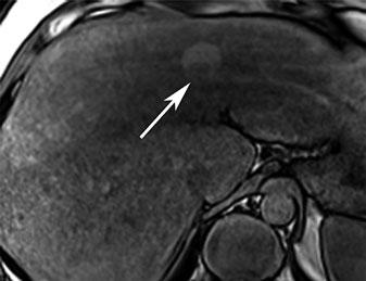 a Unenhanced CT shows a siderotic (hyperattenuating), large nodule, which contains a low-density (nonsiderotic)