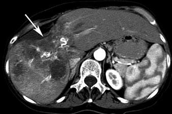 106 W. Schima, R. Baron Fig. 16 a, b. Cholangiocellular carcinoma. a Contrast-enhanced CT in the arterial phase demonstrates a multicentric hypovascular mass with capsular retraction (arrow).