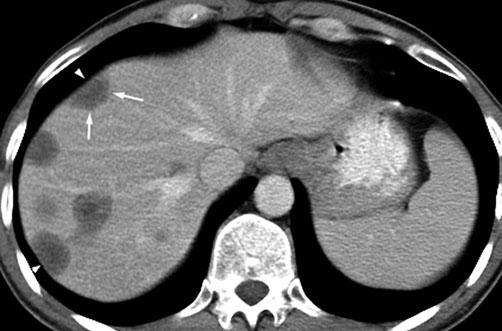 Focal Liver Lesions 107 Fig. 18. Epithelioid hemangioendothelioma. Contrast-enhanced CT (portal venous phase) shows multiple, predominantly peripherally based, hypodense lesions.