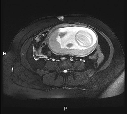If there are substantial abnormalities on these images or if initial plain radiography of the pelvis demonstrates fractures, then a delayed (and ideally relatively low-dose) CT acquisition through