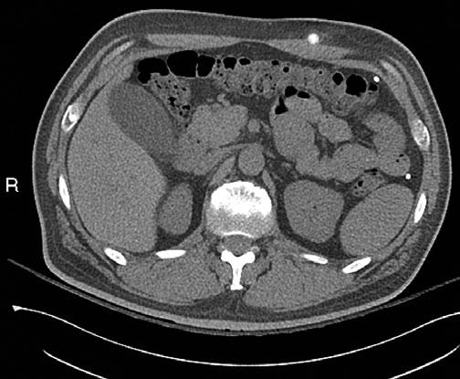 Emergency Radiology of the Abdomen and Pelvis: Imaging of the Nontraumatic and Traumatic Acute Abdomen 5 identifying and evaluating alternative conditions, including other bowel pathology (such as