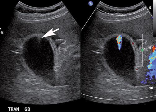 b Fat-saturated T2-weighted magnetic resonance imaging (MRI) shows two bright foci (arrow) in the wall of the gallbladder fundus that represent Rokitansky-Aschoff sinuses.