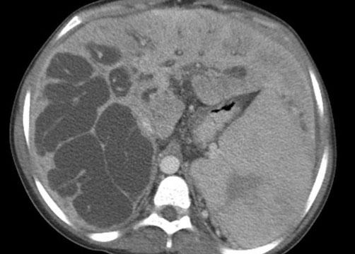 b Contrast-enhanced computed tomography (CT) using intravenously administered contrast medium in the same patient shows marked dilatation of the intrahepatic bile ducts in the right lobe, with the