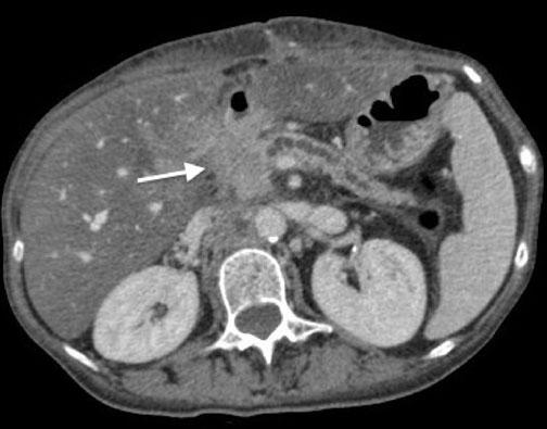 with obstructive chronic pancreatitis and infiltration of the peripancreatic fat (arrow).