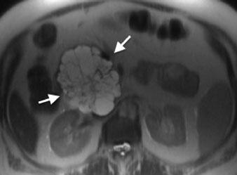 a Axial T2-weighted turbo spin-echo image (TR/TE 4,500/102) shows a multicystic microcystic neoplasm of the head of the pancreas (arrows).